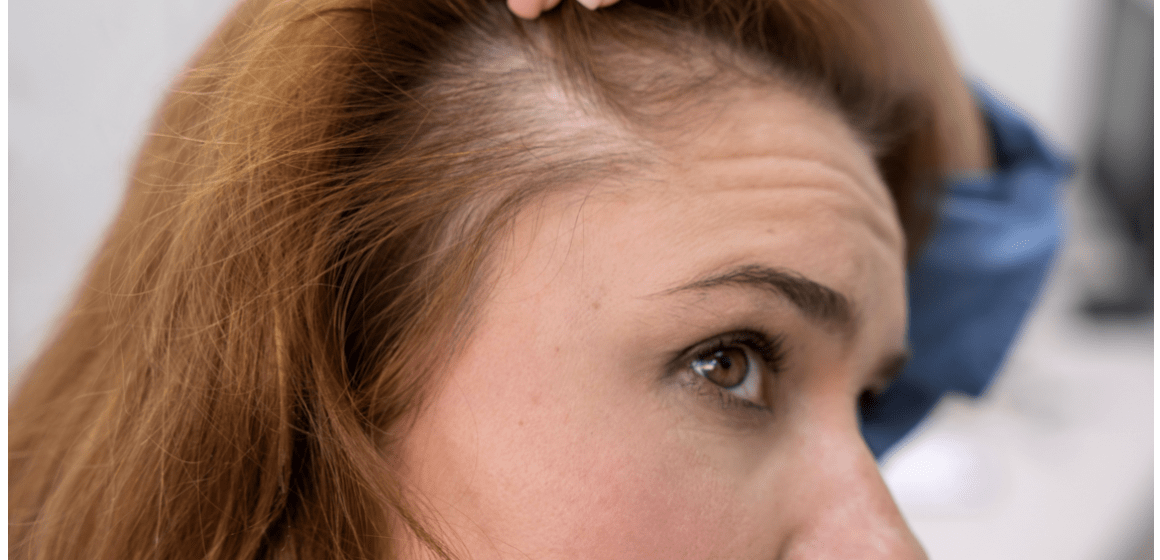Te confrunți cu un scalp sensibil? Iată ce trebuie să știi